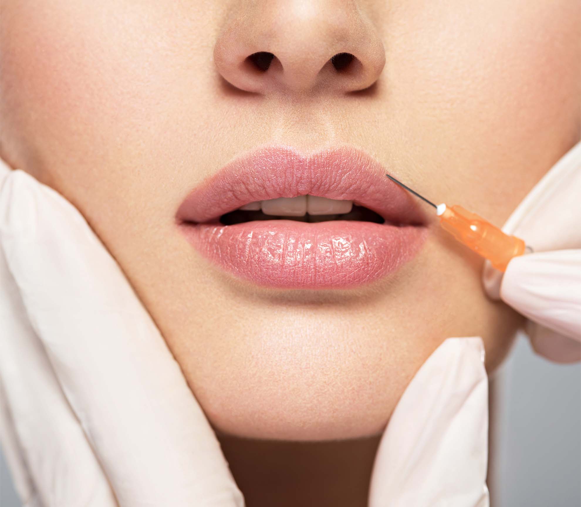 Injections acide hyaluronique lèvres : tarifs et traitements | Dr Cornil | Nice (06)