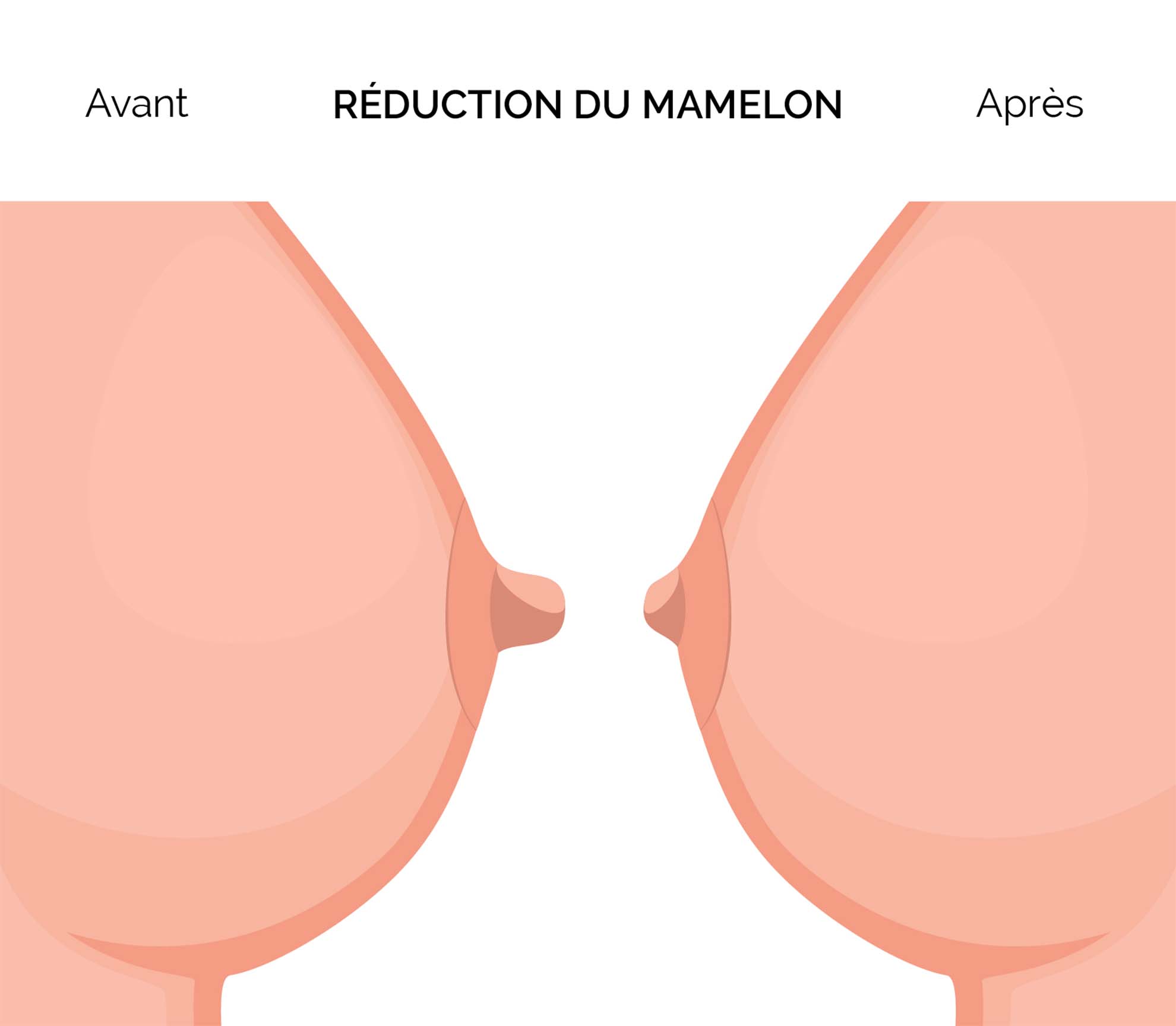 Correction mamelon : traitements | Chirurgie reconstructrice | Dr Cornil | Nice (06)